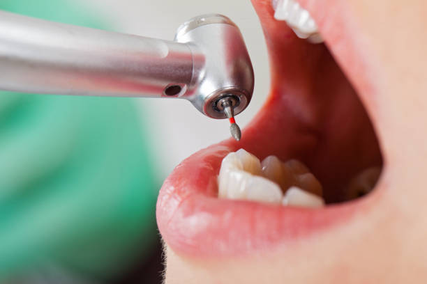 Best Root Canal Emergency Dentist  in Stewartville, AL